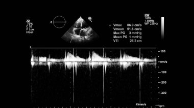 Transesofageal ultrason sırasında kalbin gri ölçekli görüntüsü.