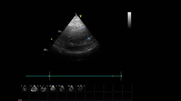 Image of the heart in gray-scale mode during transesophageal ultrasound.