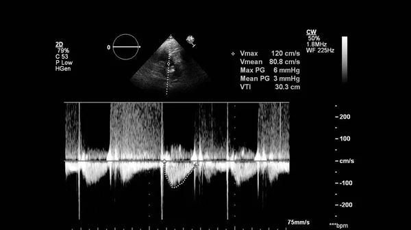 Transesofageal Ultrason Sırasında Kalbin Gri Ölçekli Görüntüsü — Stok fotoğraf