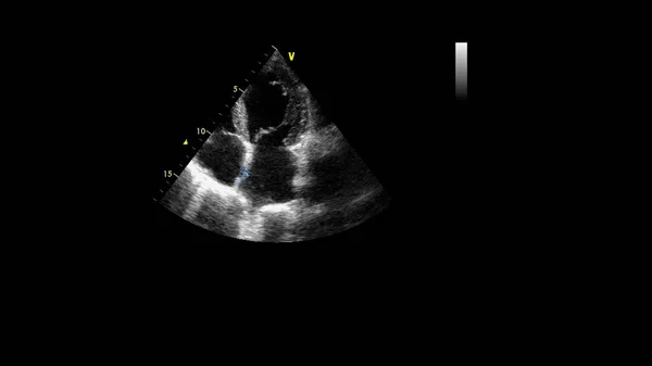 Transesofageal Ultrason Sırasında Kalbin Gri Ölçekli Görüntüsü — Stok fotoğraf