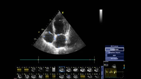 Transesofageal Ultrason Sırasında Kalbin Gri Ölçekli Görüntüsü — Stok fotoğraf