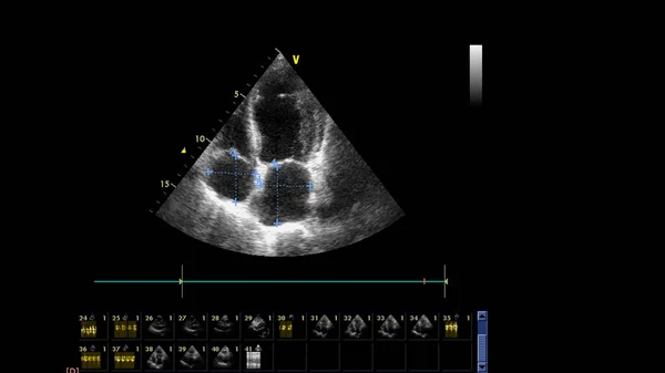 Image of the heart in gray-scale mode during transesophageal ultrasound.