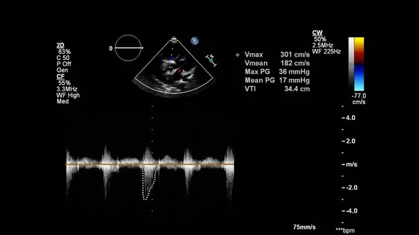 Imagem Coração Durante Ultrassom Transesofágico Com Modo Doppler — Fotografia de Stock