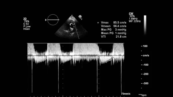 Kép Szív Szürke Skála Mód Során Transesophagealis Ultrahang — Stock Fotó