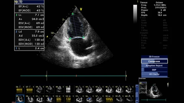 経食道超音波検査時のグレースケールモードで心臓の画像 — ストック写真