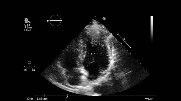 Image of the heart in gray-scale mode during transesophageal ultrasound.