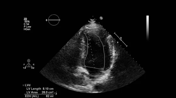 Transesofageal Ultrason Sırasında Kalbin Gri Ölçekli Görüntüsü — Stok fotoğraf