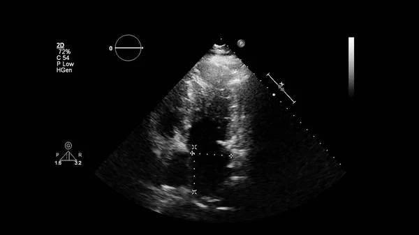 Transesofageal Ultrason Sırasında Kalbin Gri Ölçekli Görüntüsü — Stok fotoğraf