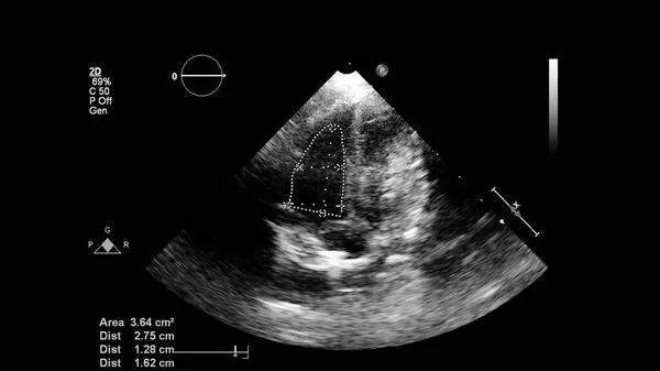 Transesofageal Ultrason Sırasında Kalbin Gri Ölçekli Görüntüsü — Stok fotoğraf