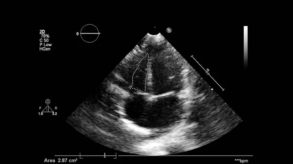 Imagem Coração Escala Cinza Durante Ultrassonografia Transesofágica — Fotografia de Stock
