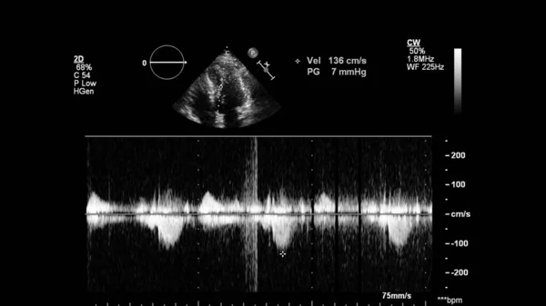 Afbeelding Van Het Hart Grijs Schaal Modus Tijdens Transesofageale Echografie — Stockfoto