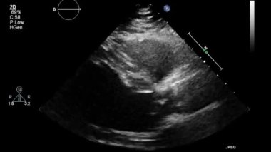 Kalbin ultrason transsofageal muayenesi.