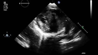 Kalbin ultrason transsofageal muayenesi.