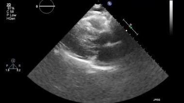 Kalbin ultrason transsofageal muayenesi.