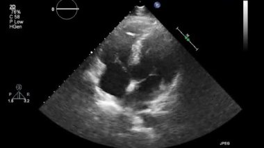 Kalbin ultrason transsofageal muayenesi.