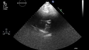 Kalbin ultrason transsofageal muayenesi.