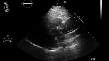 Kalbin ultrason transsofageal muayenesi.