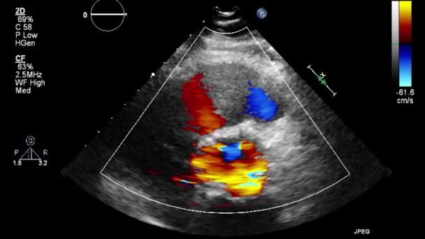 Ultrasound Transesophageal Examination Heart — Stock Video