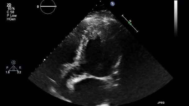 Ecografía Examen Transesofágico Del Corazón — Vídeo de stock