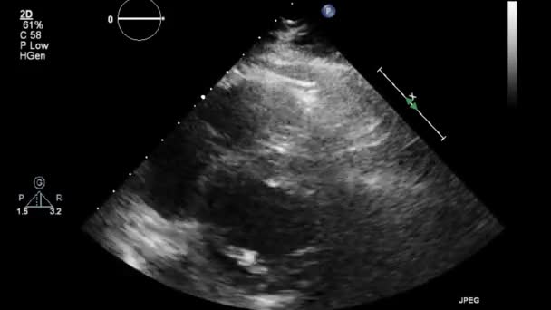 Echografie Transslokdarmonderzoek Van Het Hart — Stockvideo