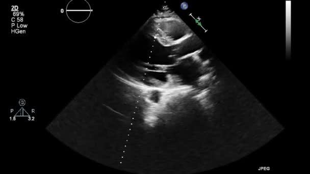 Kalbin Ultrason Transsofageal Muayenesi — Stok video