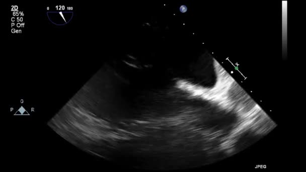 Ecografía Examen Transesofágico Del Corazón — Vídeos de Stock