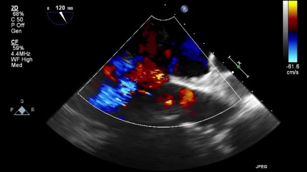 Ecografia Esame Transesofageo Del Cuore — Video Stock