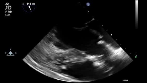 Echografie Transslokdarmonderzoek Van Het Hart — Stockvideo