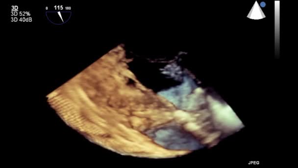 心臓の超音波経食道検査 — ストック動画
