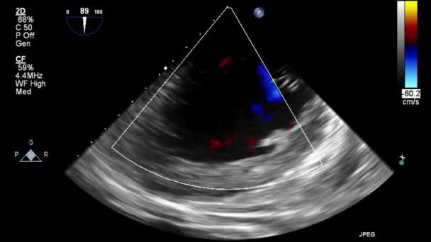 Ultrasound Transesophageal Examination Heart — Stock Video