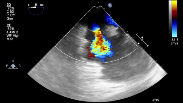 Ecografía Examen Transesofágico Del Corazón — Vídeos de Stock