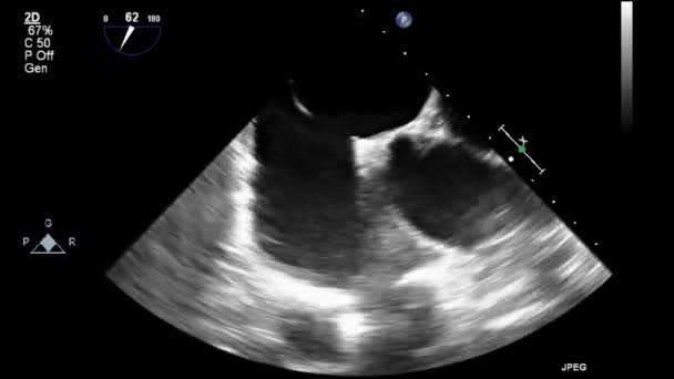 Kalbin Ultrason Transsofageal Muayenesi — Stok video