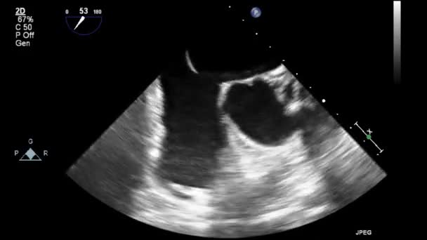 Echografie Transslokdarmonderzoek Van Het Hart — Stockvideo