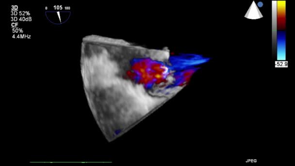 Kalbin Ultrason Transsofageal Muayenesi — Stok video