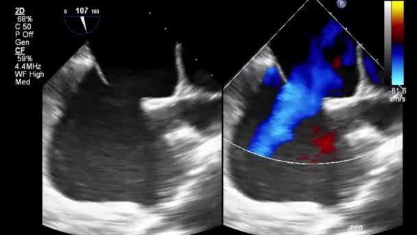 Ультразвуковое Трансофагеальное Исследование Сердца — стоковое видео