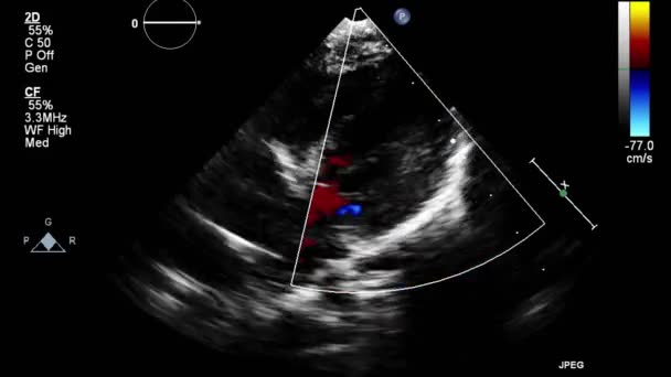 Ecografia Esame Transesofageo Del Cuore — Video Stock