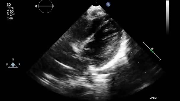 Echografie Transslokdarmonderzoek Van Het Hart — Stockvideo