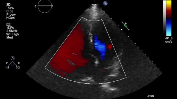 Ultrazvukové Transesofageální Vyšetření Srdce — Stock video