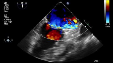 Kalbin ultrason transsofageal muayenesi.