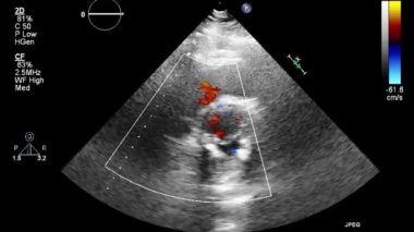 Kalbin ultrason transsofageal muayenesi.
