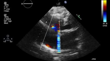 Kalbin ultrason transsofageal muayenesi.