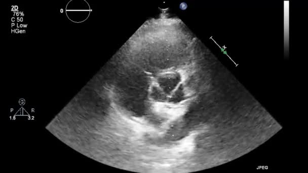 Ecografía Examen Transesofágico Del Corazón — Vídeos de Stock