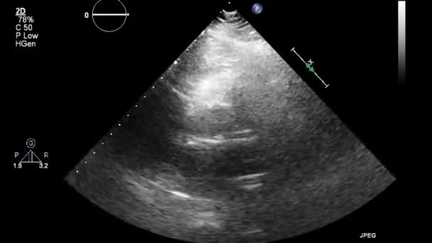 Exame Transesofágico Ultrassonográfico Coração — Vídeo de Stock