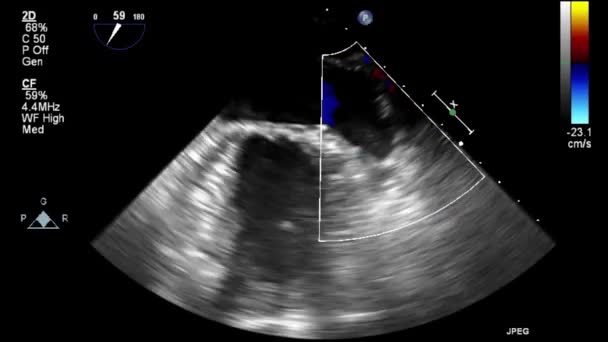 Ультразвуковое Трансофагеальное Исследование Сердца — стоковое видео