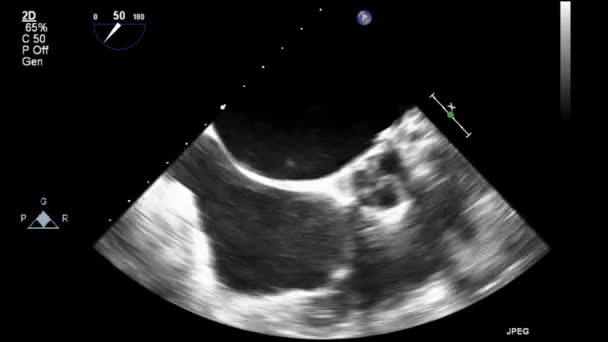 Echografie Transslokdarmonderzoek Van Het Hart — Stockvideo