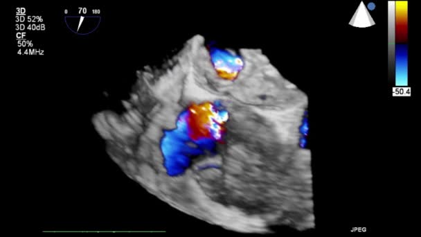 Exame Transesofágico Ultrassonográfico Coração — Vídeo de Stock