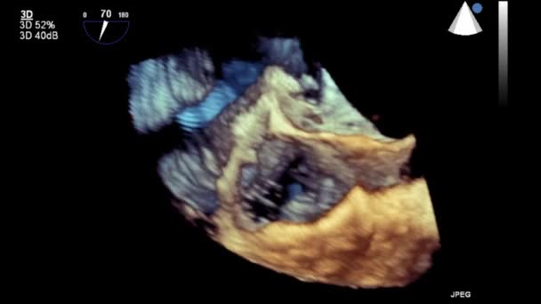 Ultrasound Transesophageal Examination Heart — Stock Video