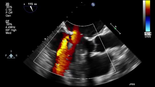 Kalbin Ultrason Transsofageal Muayenesi — Stok video