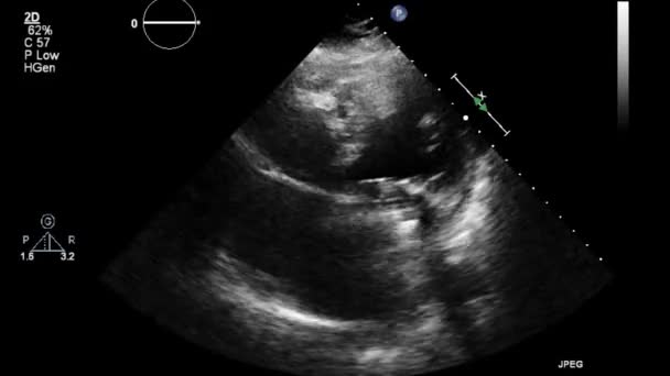 Kalbin Ultrason Transsofageal Muayenesi — Stok video