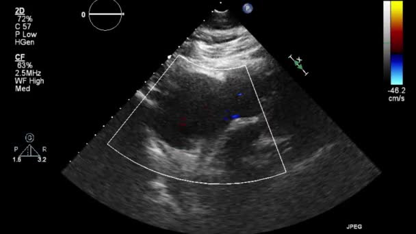 Ultrasound Transesophageal Examination Heart — Stock Video